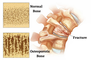 Osteoporosis