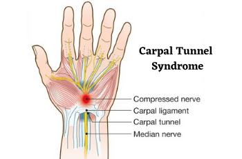 Carpal Tunnel Syndrome