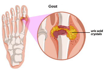 Gout