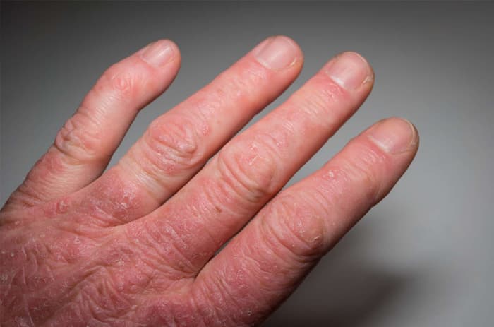 Psoriatic arthritis