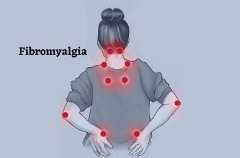 Fibromyalgia